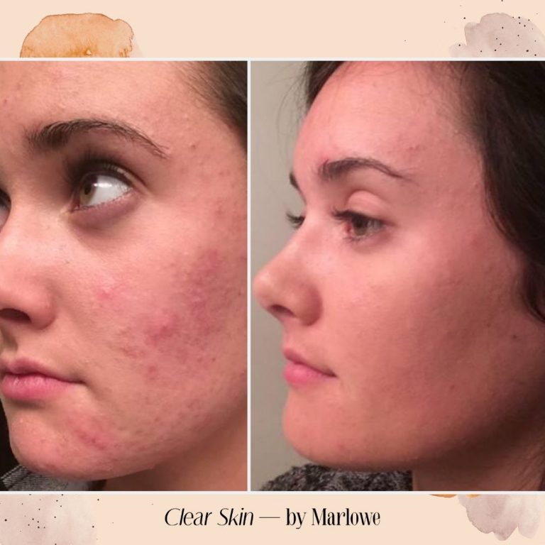 The Top 6 Foods For Clear Skin - The Acne Nutritionist Maria Marlowe