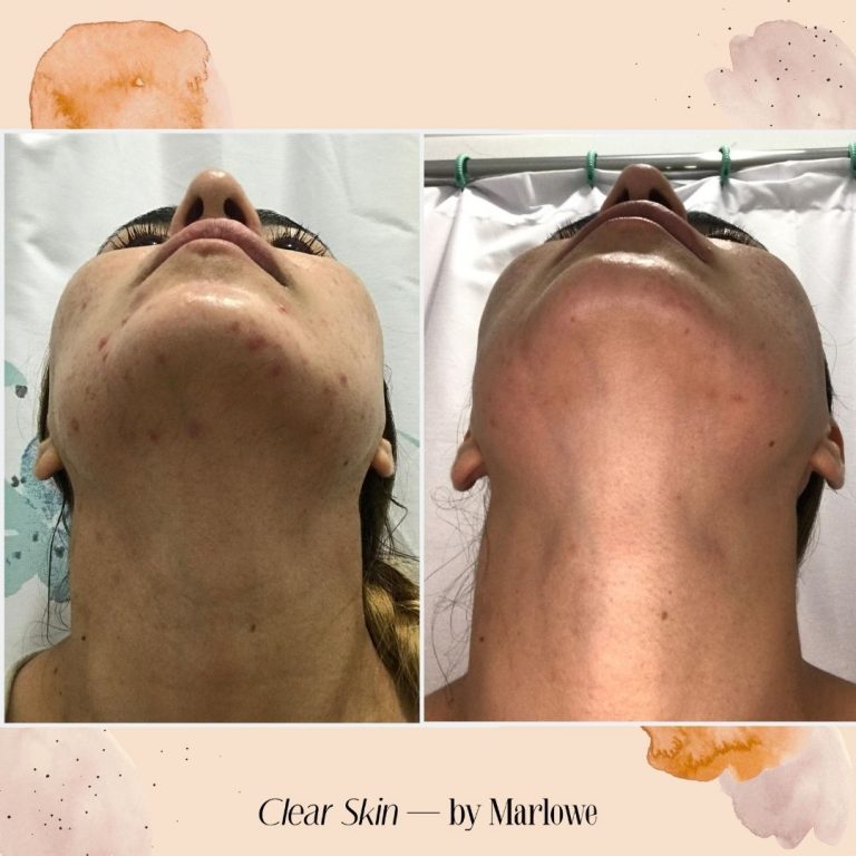 The Top 6 Foods For Clear Skin - The Acne Nutritionist Maria Marlowe