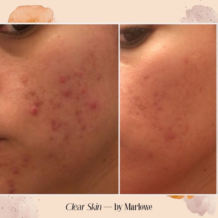 The Top 6 Foods For Clear Skin - The Acne Nutritionist Maria Marlowe