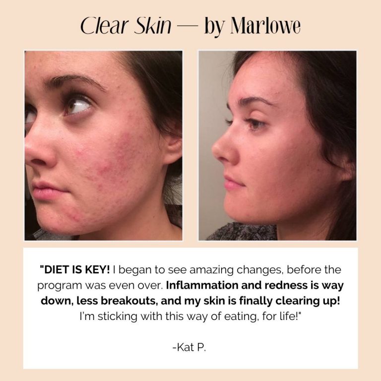 Vitamin A for Acne Why It's Essential For Clear Skin (Plus Recipes