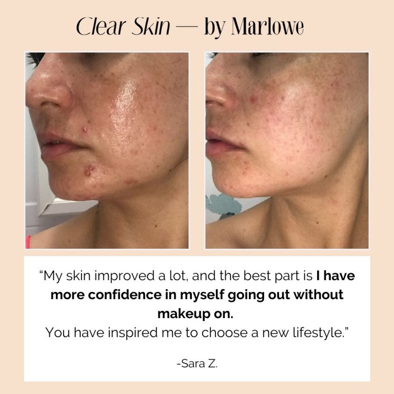 Vitamin A for Acne Why It's Essential For Clear Skin (Plus Recipes