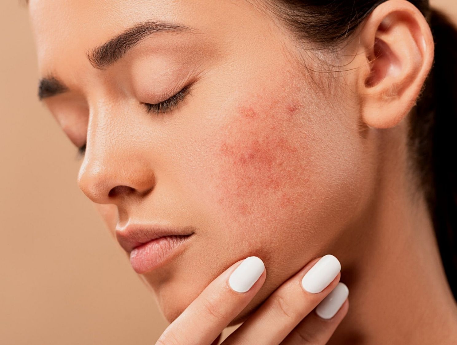 7 Ways To Get Rid Of Stress Acne Glow By Marlowe