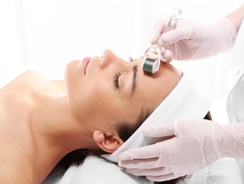 Microneedling - How to fade acne scars 